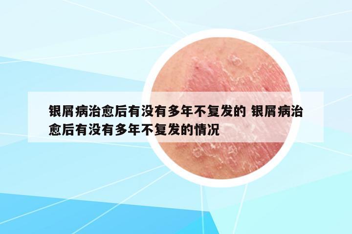 銀屑病治愈后有沒有多年不復(fù)發(fā)的 銀屑病治愈后有沒有多年不復(fù)發(fā)的情況