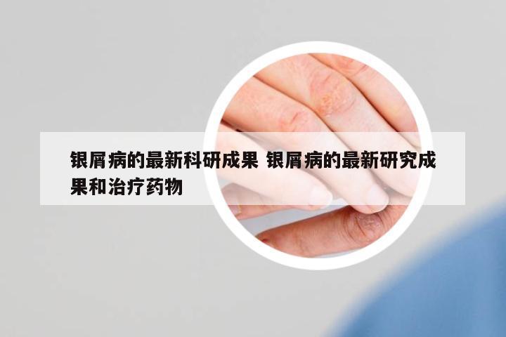 銀屑病的最新科研成果 銀屑病的最新研究成果和治療藥物