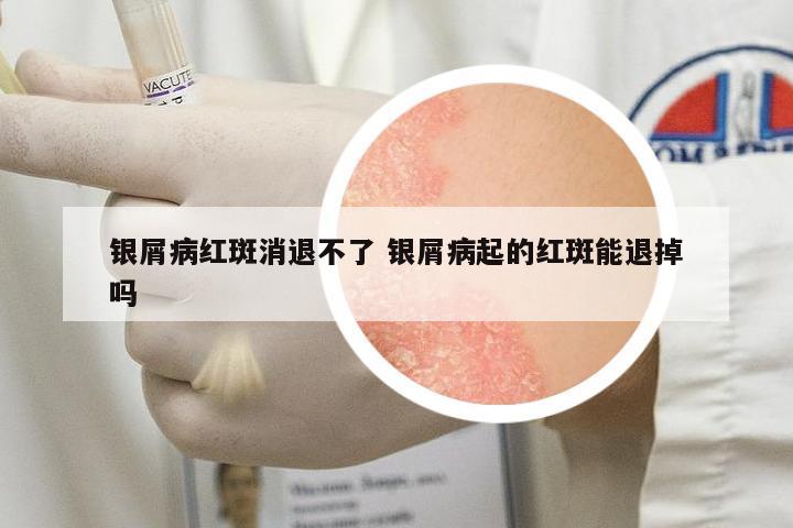 銀屑病紅斑消退不了 銀屑病起的紅斑能退掉嗎