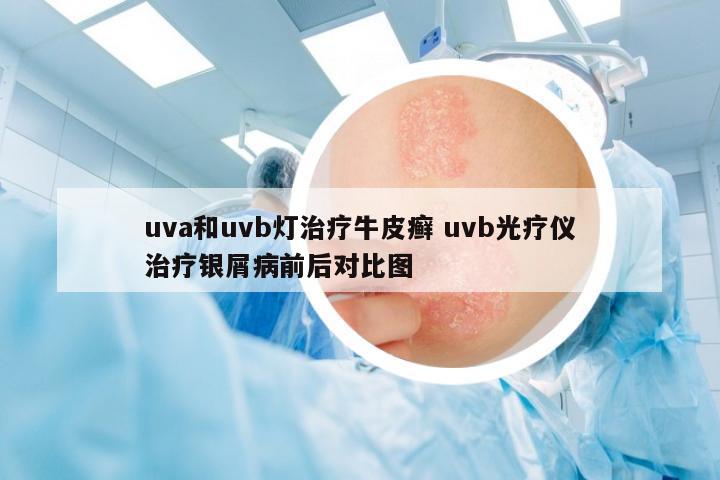 uva和uvb燈治療牛皮癬 uvb光療儀治療銀屑病前后對比圖