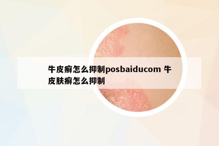 牛皮癬怎么抑制posbaiducom 牛皮膚癬怎么抑制