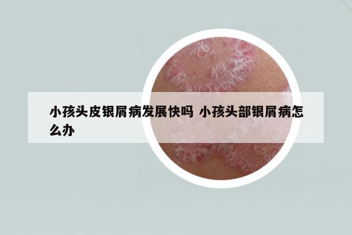 小孩頭皮銀屑病發(fā)展快嗎 小孩頭部銀屑病怎么辦