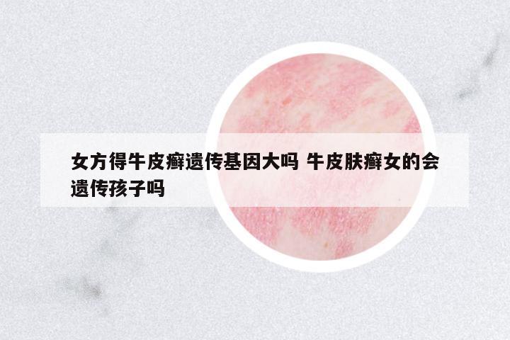 女方得牛皮癬遺傳基因大嗎 牛皮膚癬女的會遺傳孩子嗎
