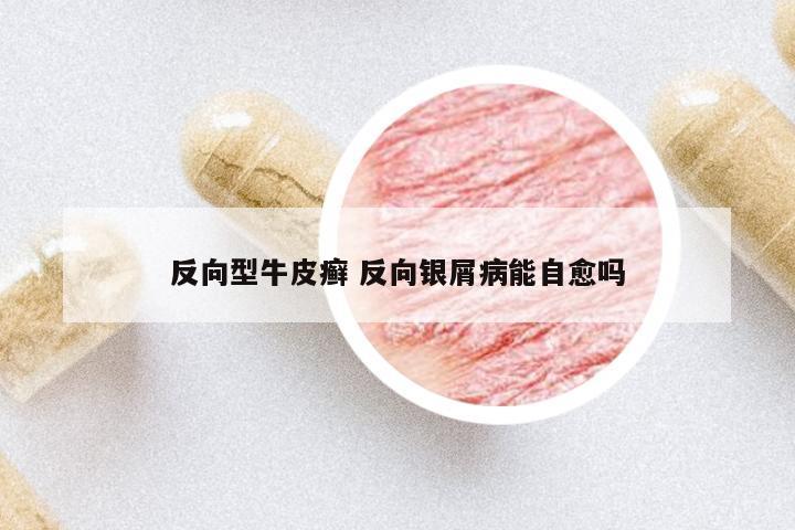 反向型牛皮癬 反向銀屑病能自愈嗎