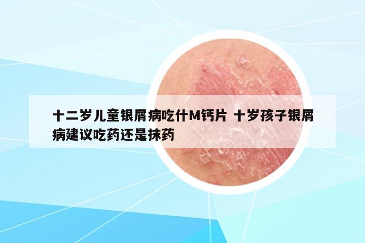 十二歲兒童銀屑病吃什M鈣片 十歲孩子銀屑病建議吃藥還是抹藥