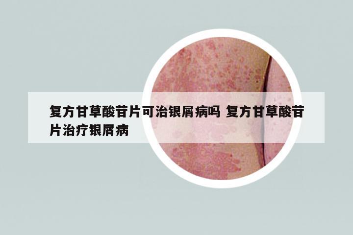復(fù)方甘草酸苷片可治銀屑病嗎 復(fù)方甘草酸苷片治療銀屑病
