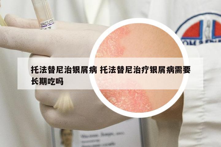 托法替尼治銀屑病 托法替尼治療銀屑病需要長期吃嗎