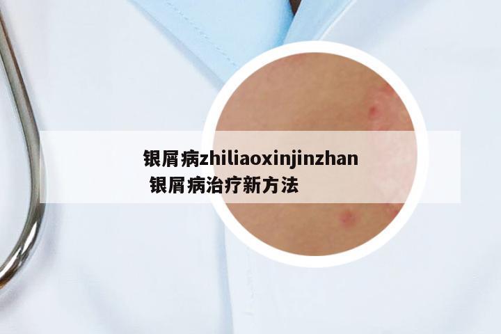 銀屑病zhiliaoxinjinzhan 銀屑病治療新方法