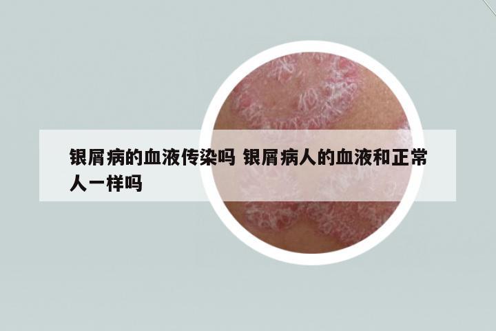 銀屑病的血液傳染嗎 銀屑病人的血液和正常人一樣嗎