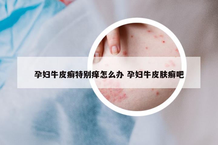孕婦牛皮癬特別癢怎么辦 孕婦牛皮膚癬吧