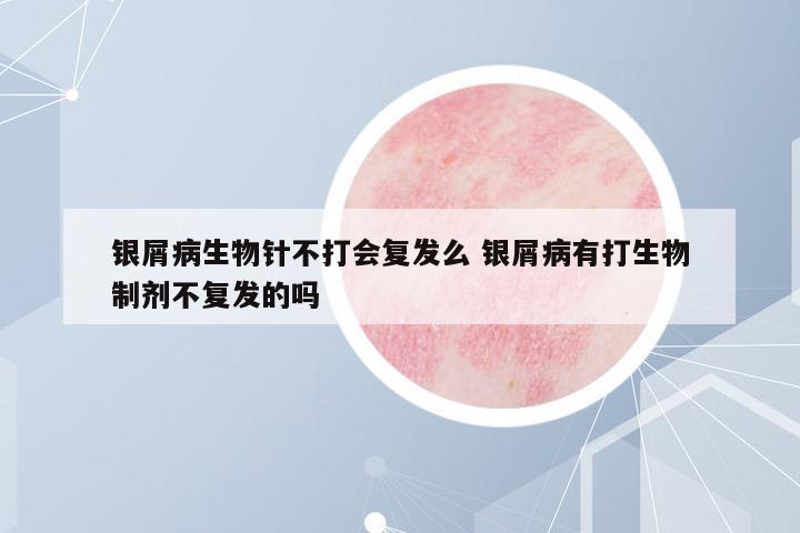 銀屑病生物針不打會(huì)復(fù)發(fā)么 銀屑病有打生物制劑不復(fù)發(fā)的嗎