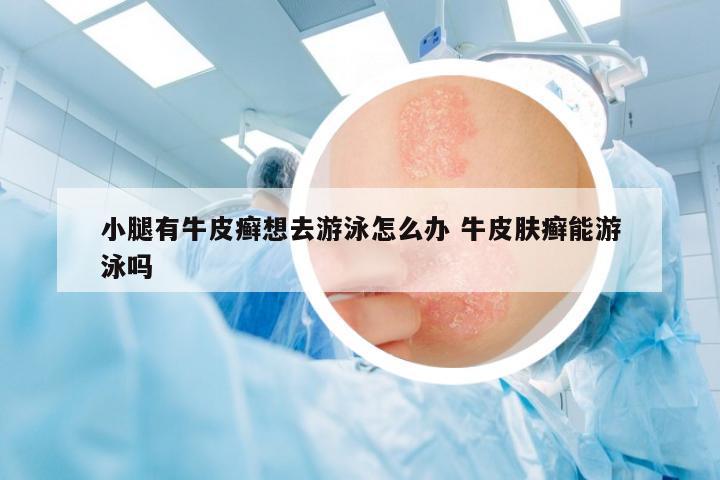 小腿有牛皮癬想去游泳怎么辦 牛皮膚癬能游泳嗎