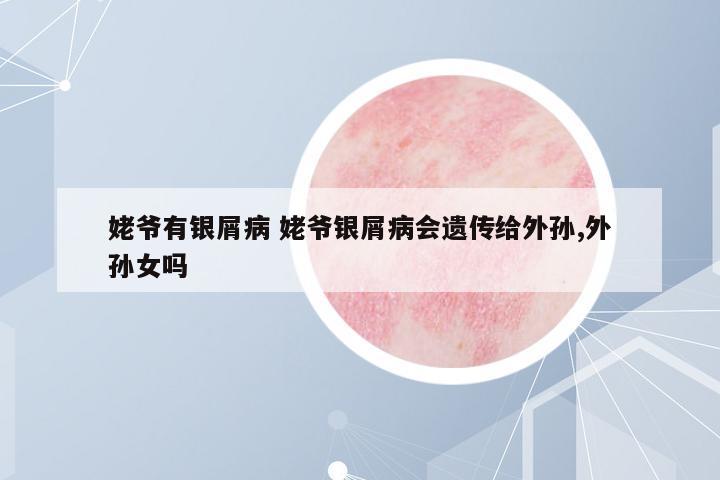 姥爺有銀屑病 姥爺銀屑病會遺傳給外孫,外孫女嗎