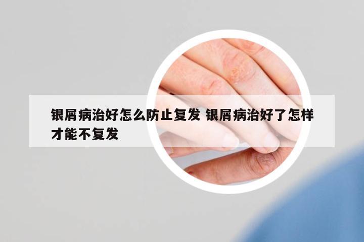 銀屑病治好怎么防止復(fù)發(fā) 銀屑病治好了怎樣才能不復(fù)發(fā)