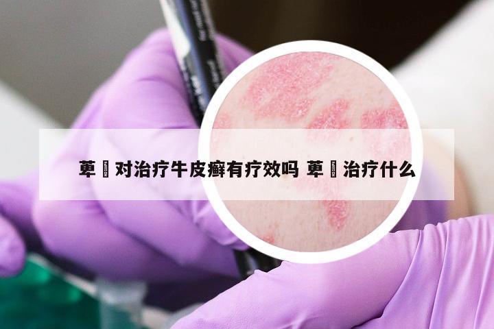 萆薢對治療牛皮癬有療效嗎 萆薢治療什么