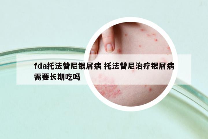 fda托法替尼銀屑病 托法替尼治療銀屑病需要長(zhǎng)期吃嗎