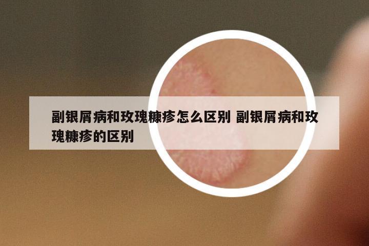 副銀屑病和玫瑰糠疹怎么區(qū)別 副銀屑病和玫瑰糠疹的區(qū)別