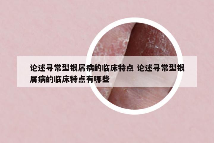 論述尋常型銀屑病的臨床特點(diǎn) 論述尋常型銀屑病的臨床特點(diǎn)有哪些