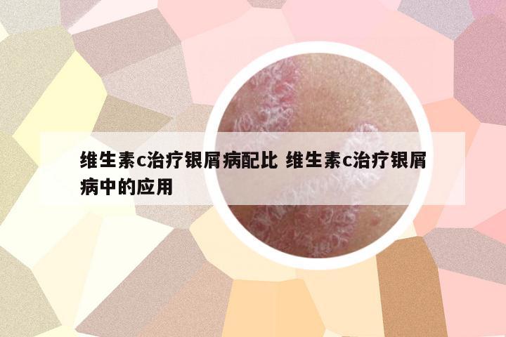 維生素c治療銀屑病配比 維生素c治療銀屑病中的應(yīng)用