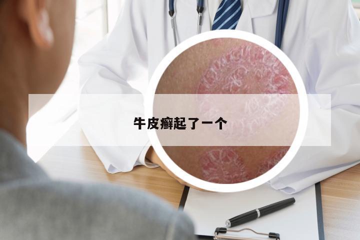 牛皮癬起了一個(gè)