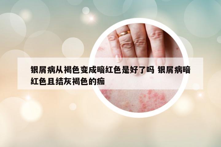 銀屑病從褐色變成暗紅色是好了嗎 銀屑病暗紅色且結(jié)灰褐色的痂