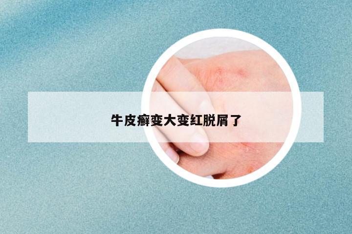牛皮癬變大變紅脫屑了