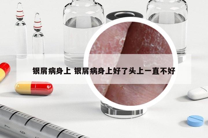 銀屑病身上 銀屑病身上好了頭上一直不好