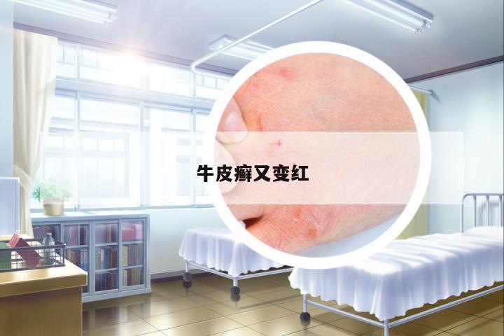 牛皮癬又變紅