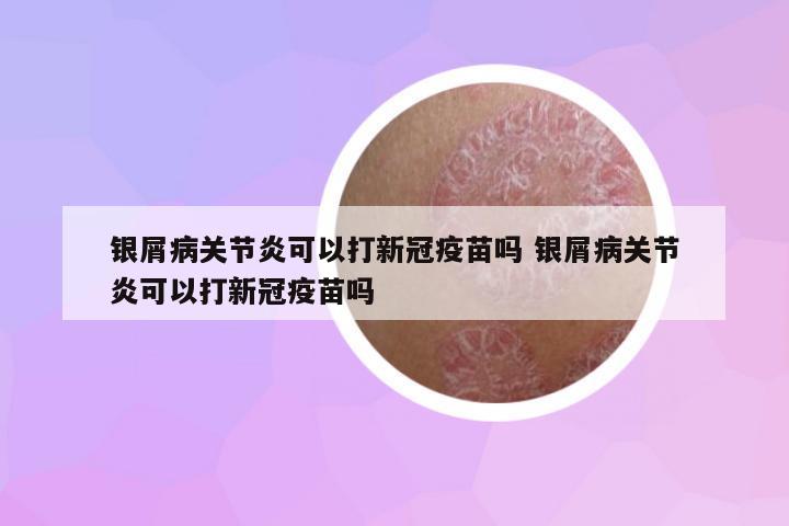 銀屑病關(guān)節(jié)炎可以打新冠疫苗嗎 銀屑病關(guān)節(jié)炎可以打新冠疫苗嗎