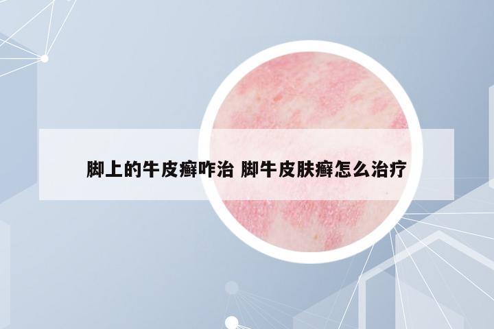 腳上的牛皮癬咋治 腳牛皮膚癬怎么治療