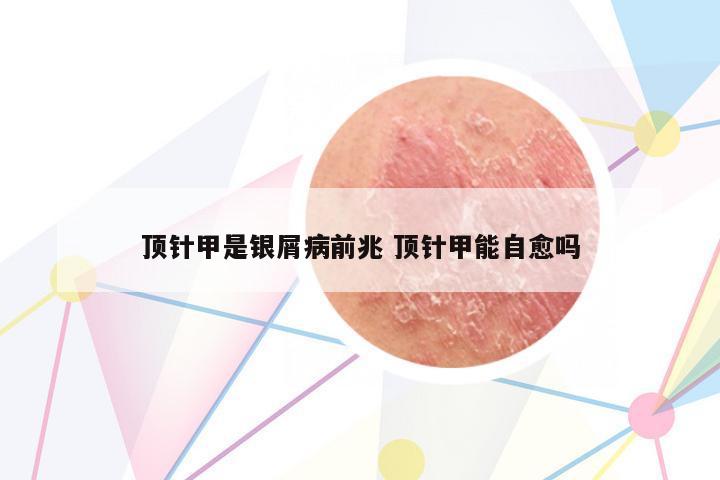 頂針甲是銀屑病前兆 頂針甲能自愈嗎