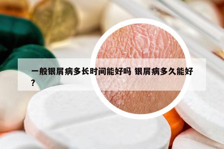 一般銀屑病多長(zhǎng)時(shí)間能好嗎 銀屑病多久能好?