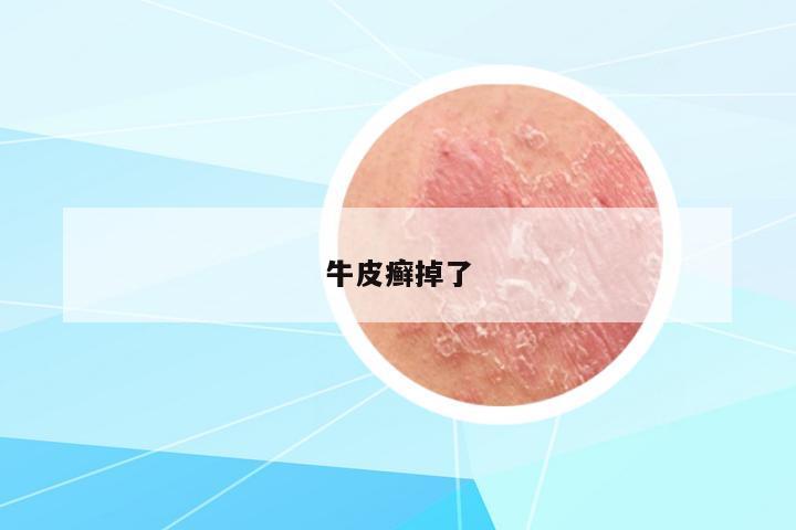 牛皮癬掉了