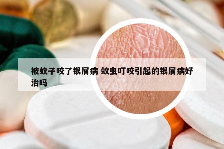 被蚊子咬了銀屑病 蚊蟲叮咬引起的銀屑病好治嗎