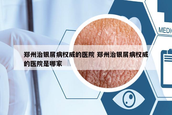 鄭州治銀屑病權(quán)威的醫(yī)院 鄭州治銀屑病權(quán)威的醫(yī)院是哪家