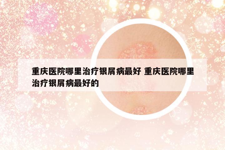 重慶醫(yī)院哪里治療銀屑病最好 重慶醫(yī)院哪里治療銀屑病最好的