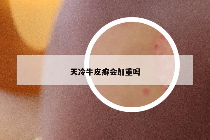 天冷牛皮癬會加重嗎