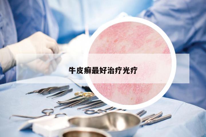 牛皮癬最好治療光療