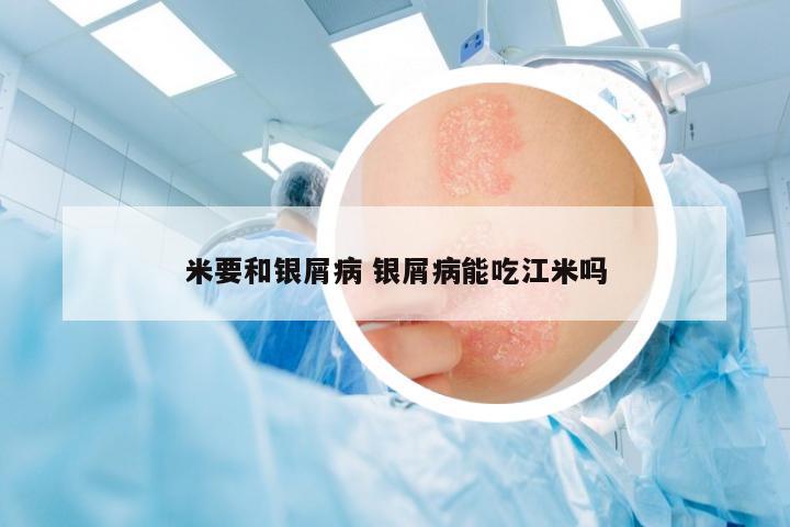 米要和銀屑病 銀屑病能吃江米嗎