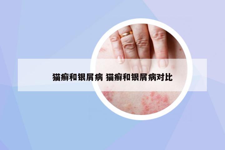 貓癬和銀屑病 貓癬和銀屑病對(duì)比