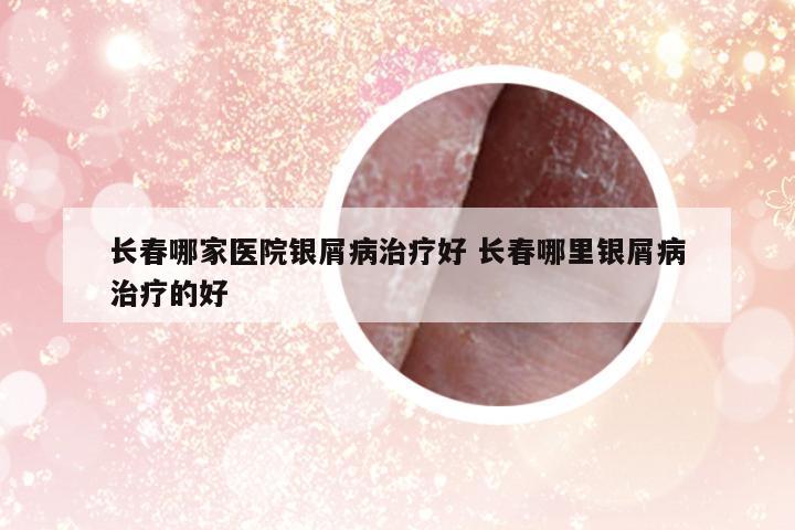 長(zhǎng)春哪家醫(yī)院銀屑病治療好 長(zhǎng)春哪里銀屑病治療的好