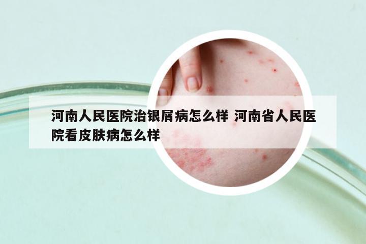河南人民醫(yī)院治銀屑病怎么樣 河南省人民醫(yī)院看皮膚病怎么樣