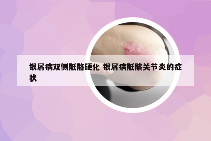 銀屑病雙側(cè)骶骼硬化 銀屑病骶髂關(guān)節(jié)炎的癥狀