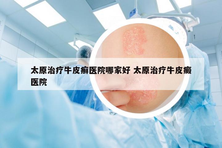 太原治療牛皮癬醫(yī)院哪家好 太原治療牛皮癜醫(yī)院