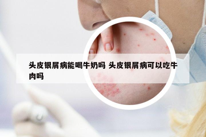 頭皮銀屑病能喝牛奶嗎 頭皮銀屑病可以吃牛肉嗎