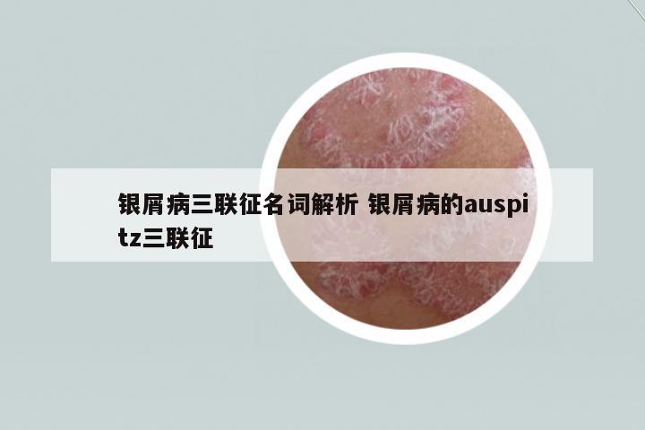銀屑病三聯(lián)征名詞解析 銀屑病的auspitz三聯(lián)征