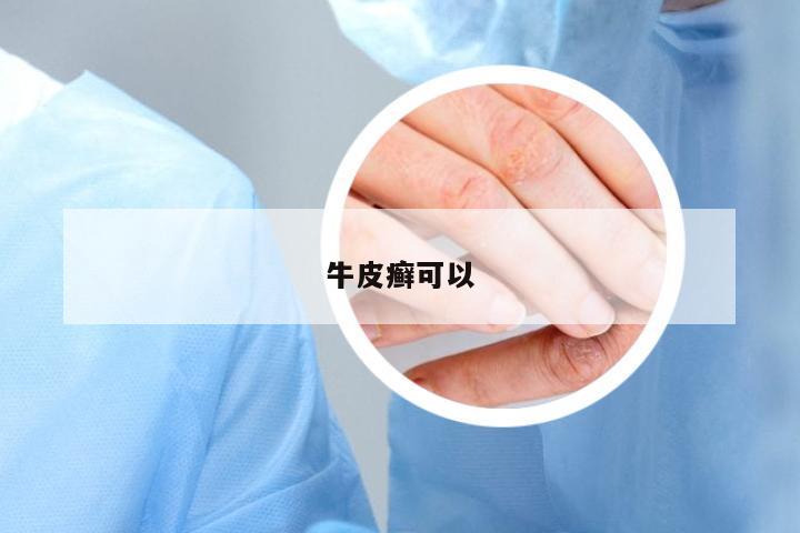 牛皮癬可以