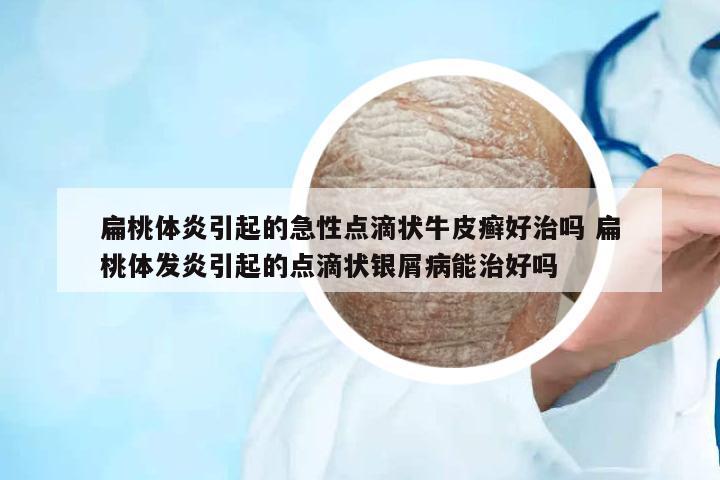 扁桃體炎引起的急性點(diǎn)滴狀牛皮癬好治嗎 扁桃體發(fā)炎引起的點(diǎn)滴狀銀屑病能治好嗎