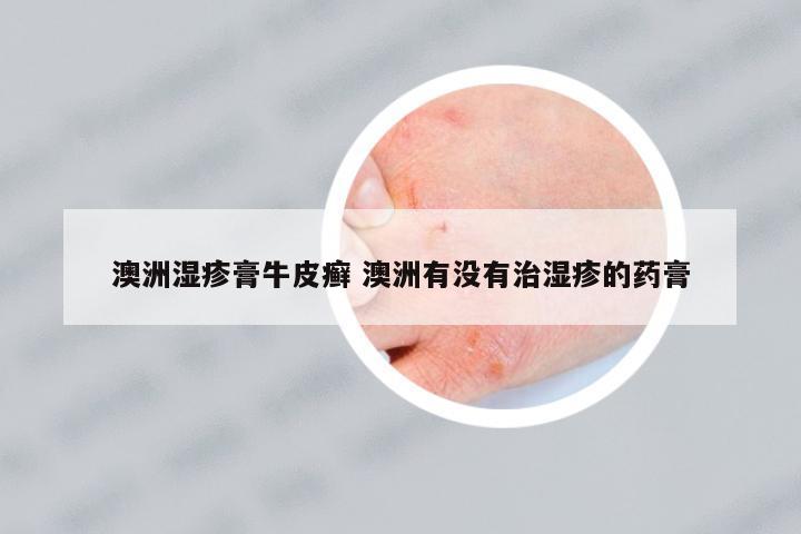 澳洲濕疹膏牛皮癬 澳洲有沒有治濕疹的藥膏