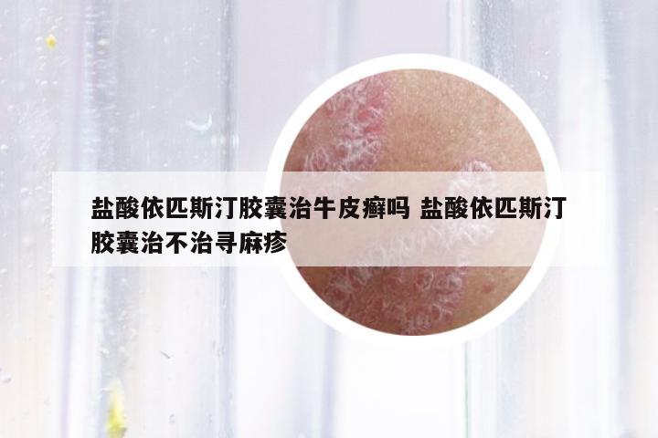 鹽酸依匹斯汀膠囊治牛皮癬嗎 鹽酸依匹斯汀膠囊治不治尋麻疹